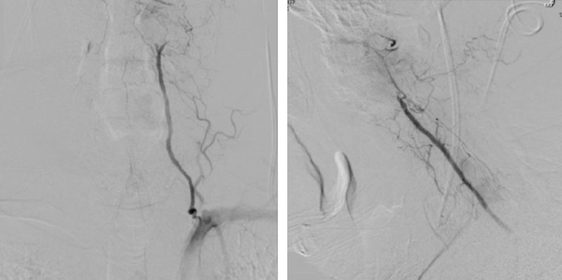Right Vertebral Artery Compression Syndrome 4