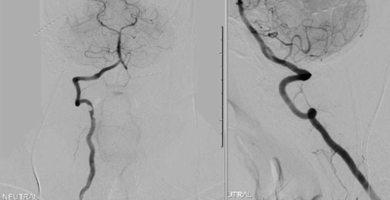 Right Vertebral Artery Compression Syndrome 5
