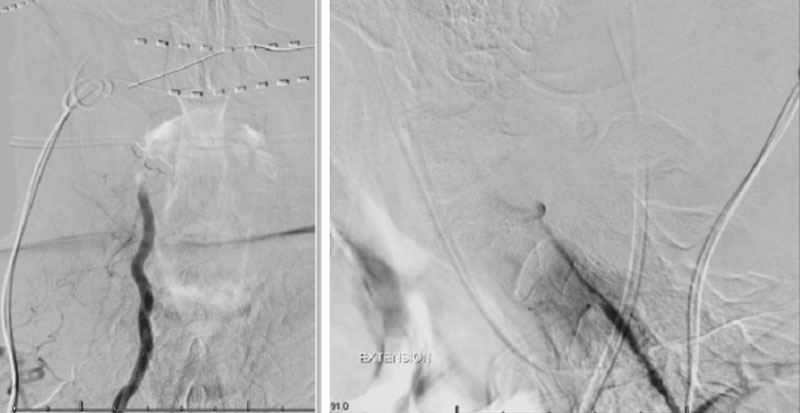 Right Vertebral Artery Compression Syndrome 6
