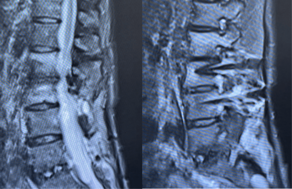 Sagittal T2 MRIs of the lumbar spine demonstrating L2-3 stenosis after L3-4 instrumented fusion