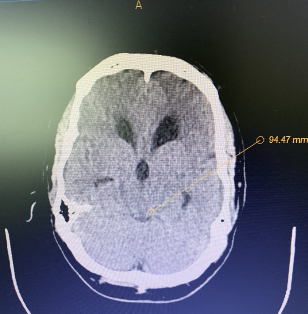 Pre-operative MRI
