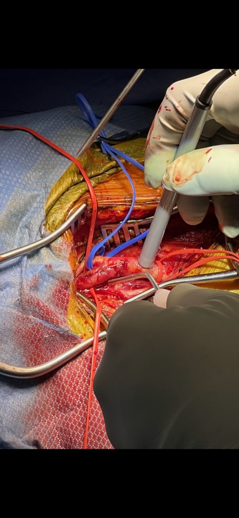 Doppler confirms patency of all vessels after closure