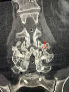 IMG_0939 Fig.2: Coronal lumbar CT demonstrating L4-S1 fusion with instrumentation with some incomplete bony fusion to the L3-4 segment (red arrow)