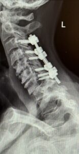 BRC Case Study - Post-op Photo Fig. 2 BRC Case Study - Post-op Photo Fig. 1