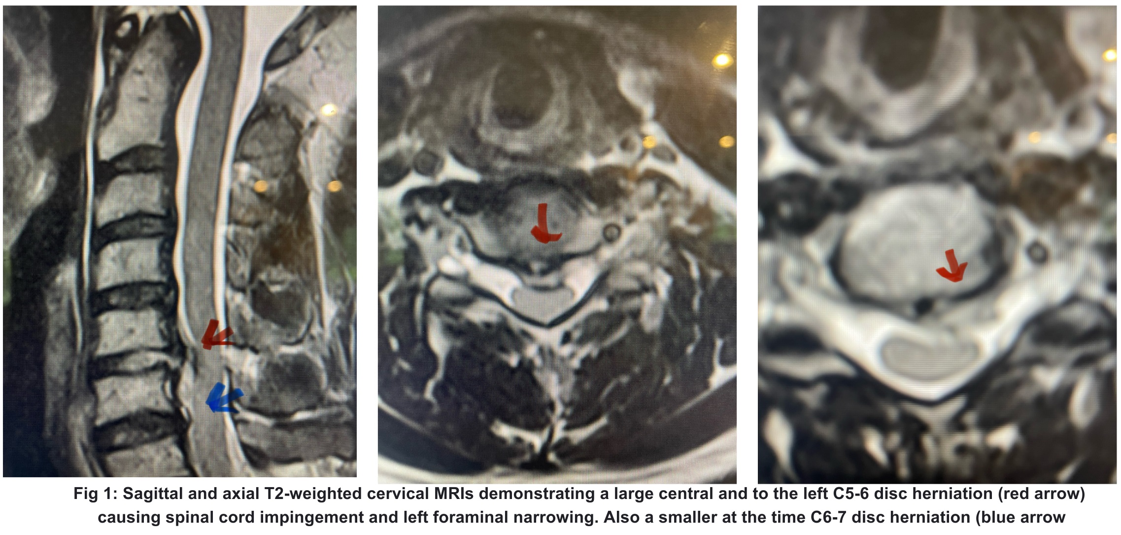 NSPC-Brain-Spine-Surgery fig 1 NSPC-Brain-Spine-Surgery fig 1